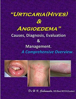 [3c6d5] !R.e.a.d@ “Urticaria (Hives) & Angioedema”-Causes, Diagnosis, Evaluation & Management. A Comprehensive Overview. - Dr.Hakim. Saboowala %PDF%